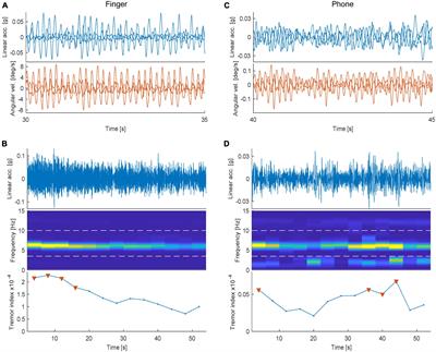 Tremor evaluation using smartphone accelerometry in standardized settings